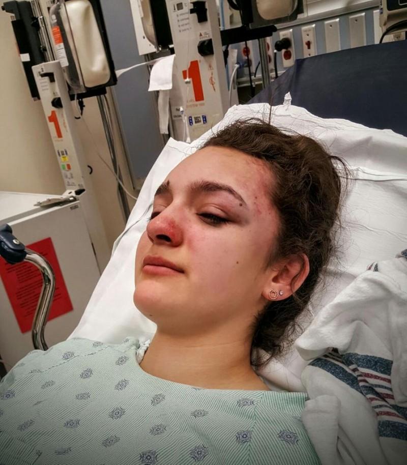 DePaul freshman Jessica Hughes was attacked on the CTA Blue Lines Thursday returning home from class. (Photo courtesy of JESSICA HUGHES)